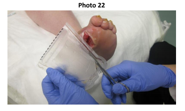 Wound Treatment | ABWH