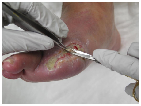 Wound Care | ABWH
