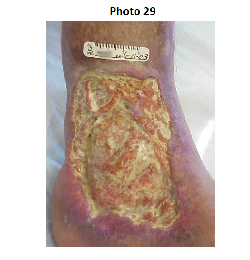 Ankle Wound | ABWH