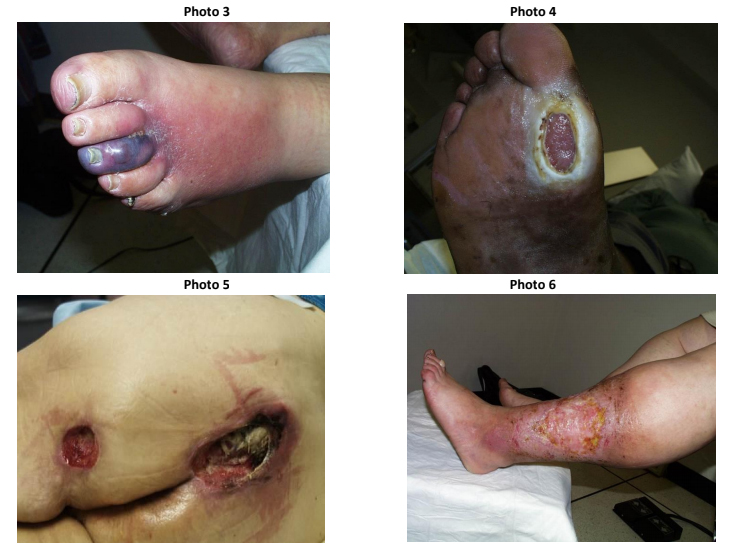 Wound Samples | ABWH