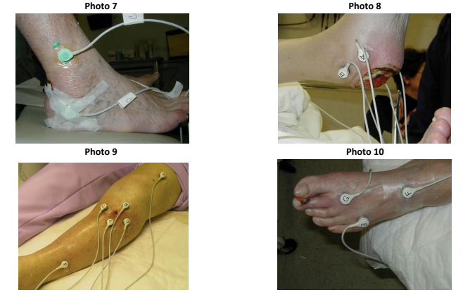 Wound Types | ABWH