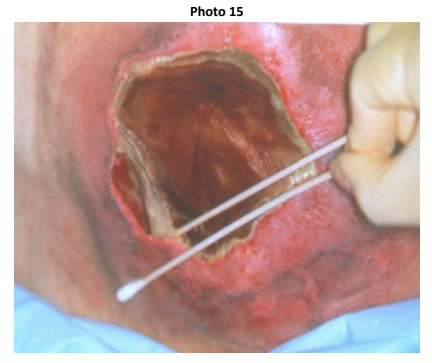 Wound Cleaning | ABWH
