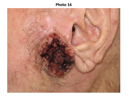 Ear Wound | ABWH