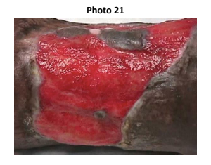 Wound Sample | ABWH